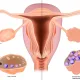 Cos’è l’OHSS (Sindrome da Iperstimolazione Ovarica)?